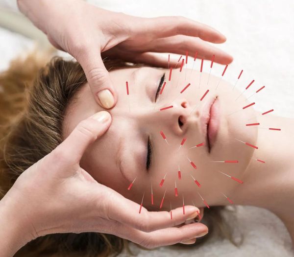 Acupuncture for stress relief Chennai